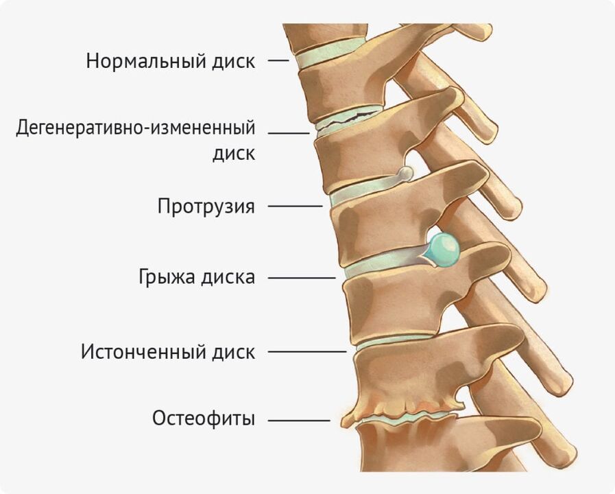 Disk deformations for lumbar osteochondrosis