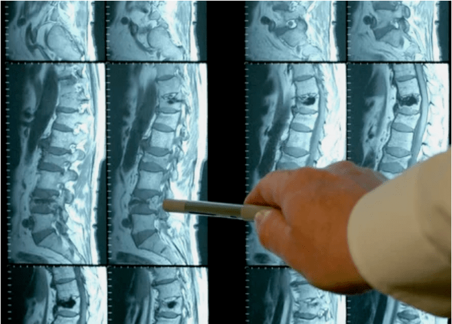 Osteochondrosis varieties in the back