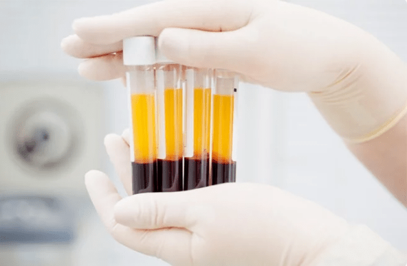 Prp therapy