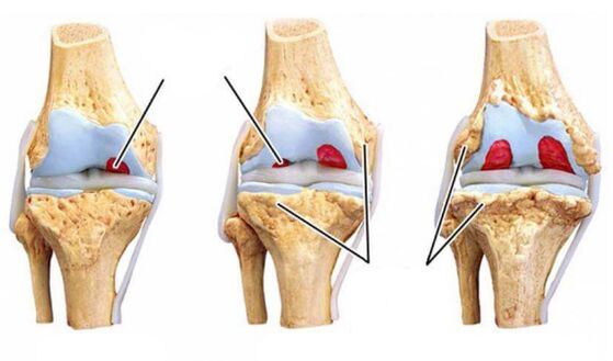 arthritis