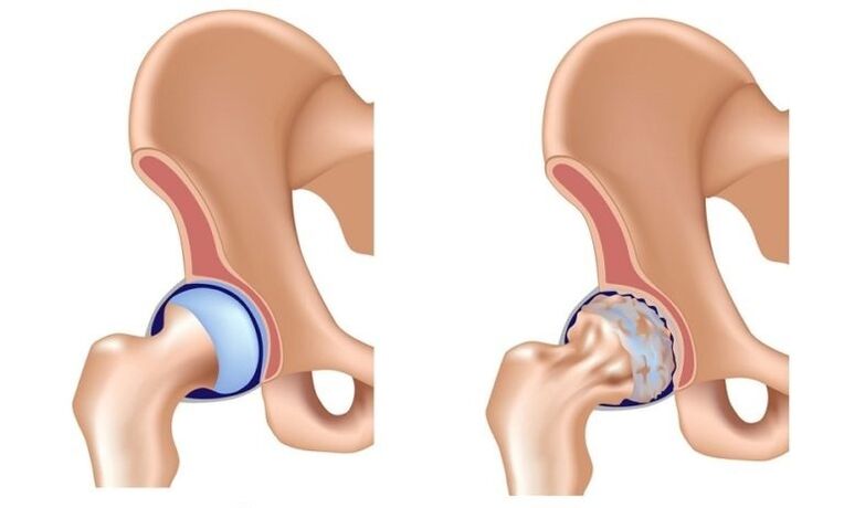 Healthy and common joint with arthrosis