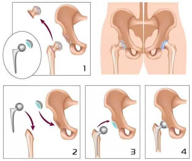Replacing a sore knot with a prosthesis