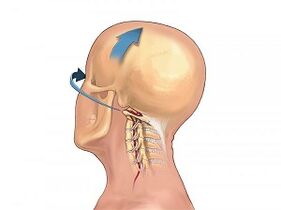 How manifested osteochondrosis of the cervical spine