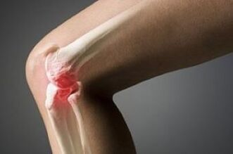 Knee joint arthrosis is a cartilage tissue lesion