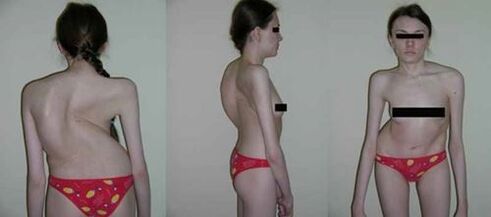 spinal cord bending as a result of osteochondrosis