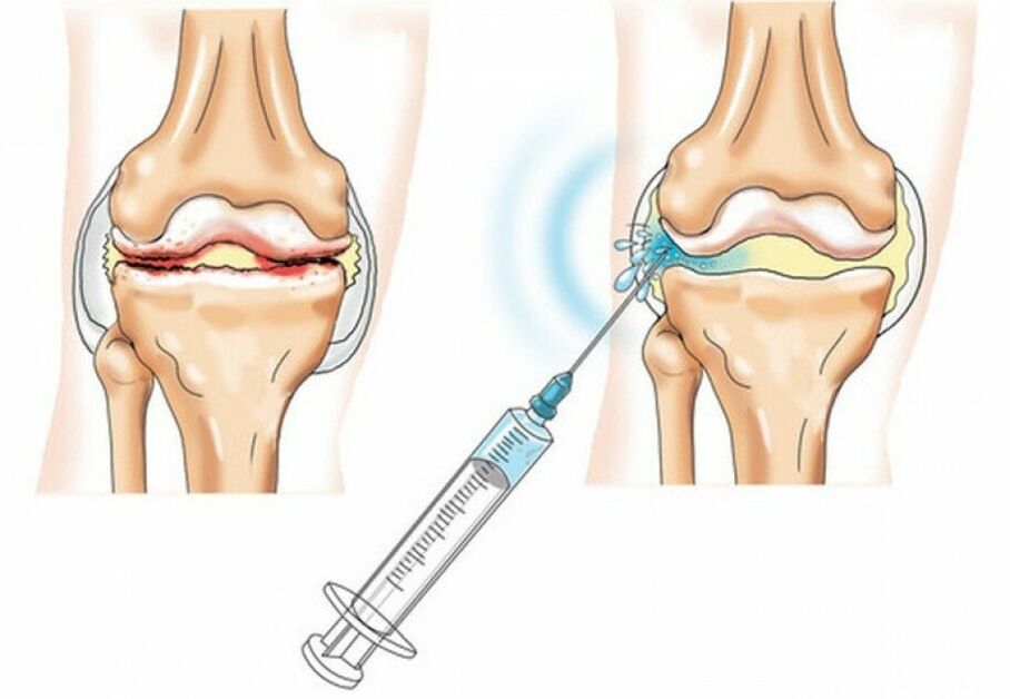 injection in the knee joint with arthrosis