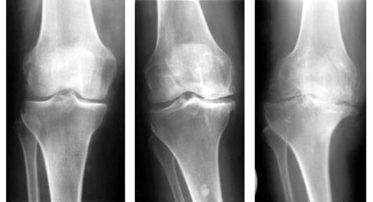 A mandatory diagnostic measure when knee arthrosis is identified is an x-ray