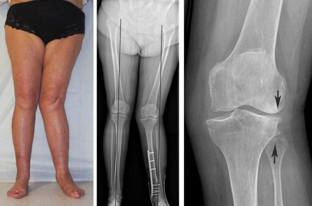 Advanced arthrosis of the knee joints is clearly visible visually even without an x-ray