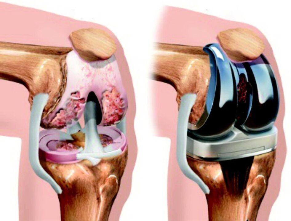 In case of total damage to the knee joint from arthrosis, it can be recovered with endoprosthetics. 